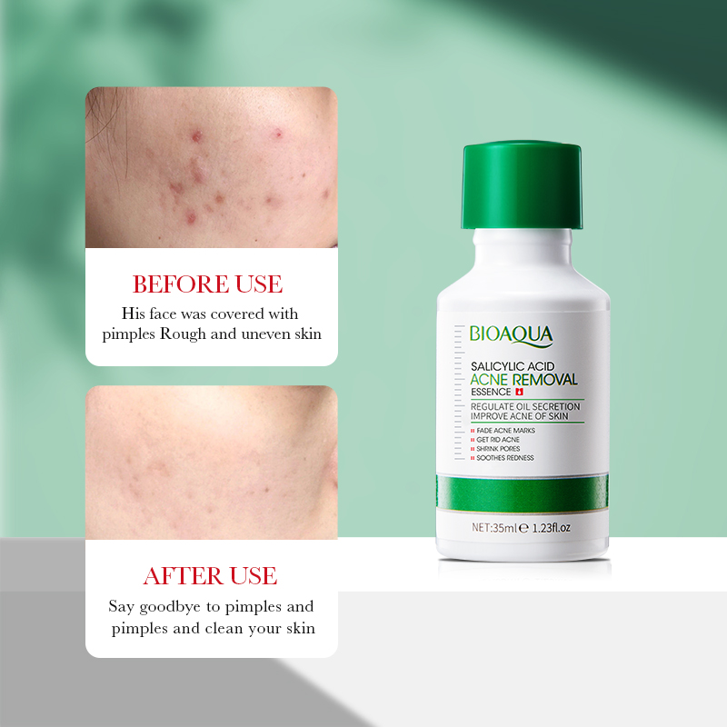 35ml BIOAOUA Salicylic Acid An - Salicylic Acid Blackhead Remover บทวิจารณ์และราคา