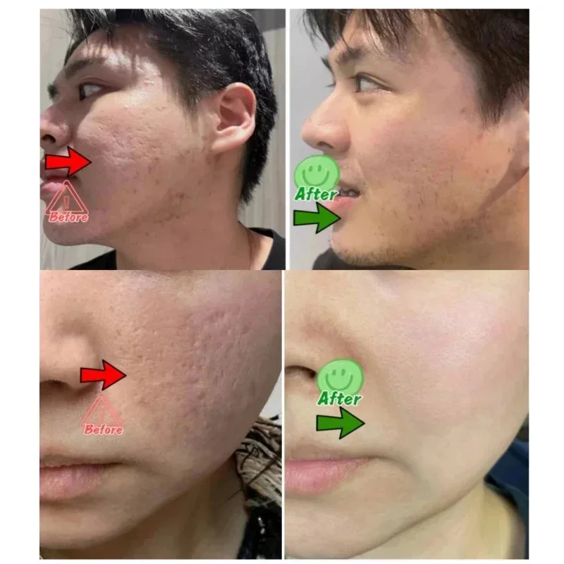 Salicylic Acid Pore Clearing C - Salicylic Acid Blackhead Remover บทวิจารณ์และราคา