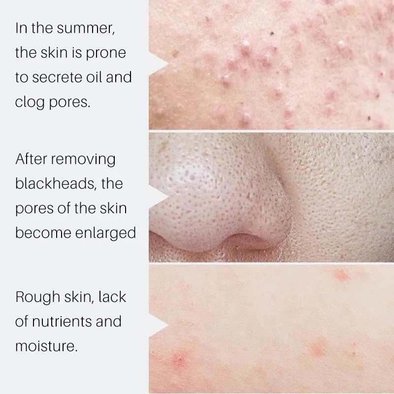 เซรั่มลดรูขุมขนกรดซาลิไซลิก กำ - Salicylic Acid Blackhead Remover บทวิจารณ์และราคา
