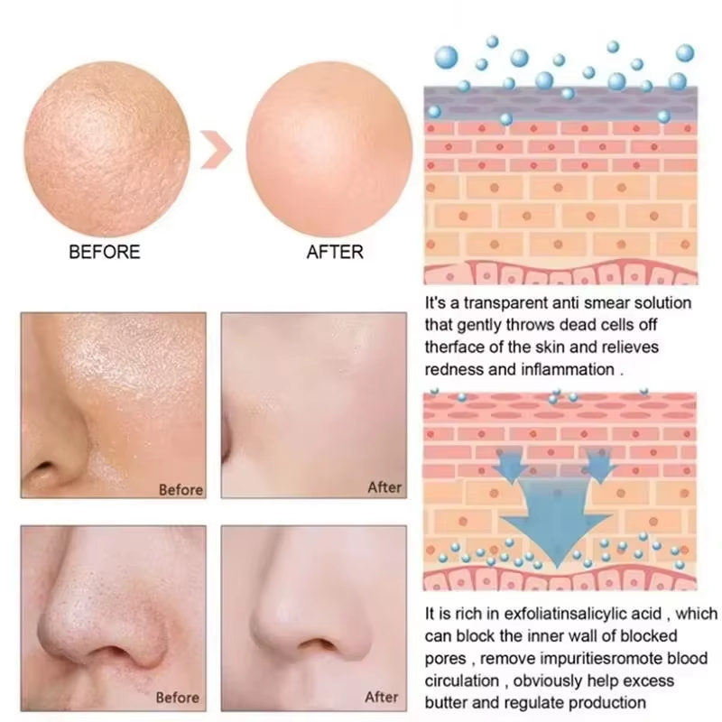 เซรั่มลดรูขุมขนกรดซาลิไซลิก กำ - Salicylic Acid Blackhead Remover บทวิจารณ์และราคา