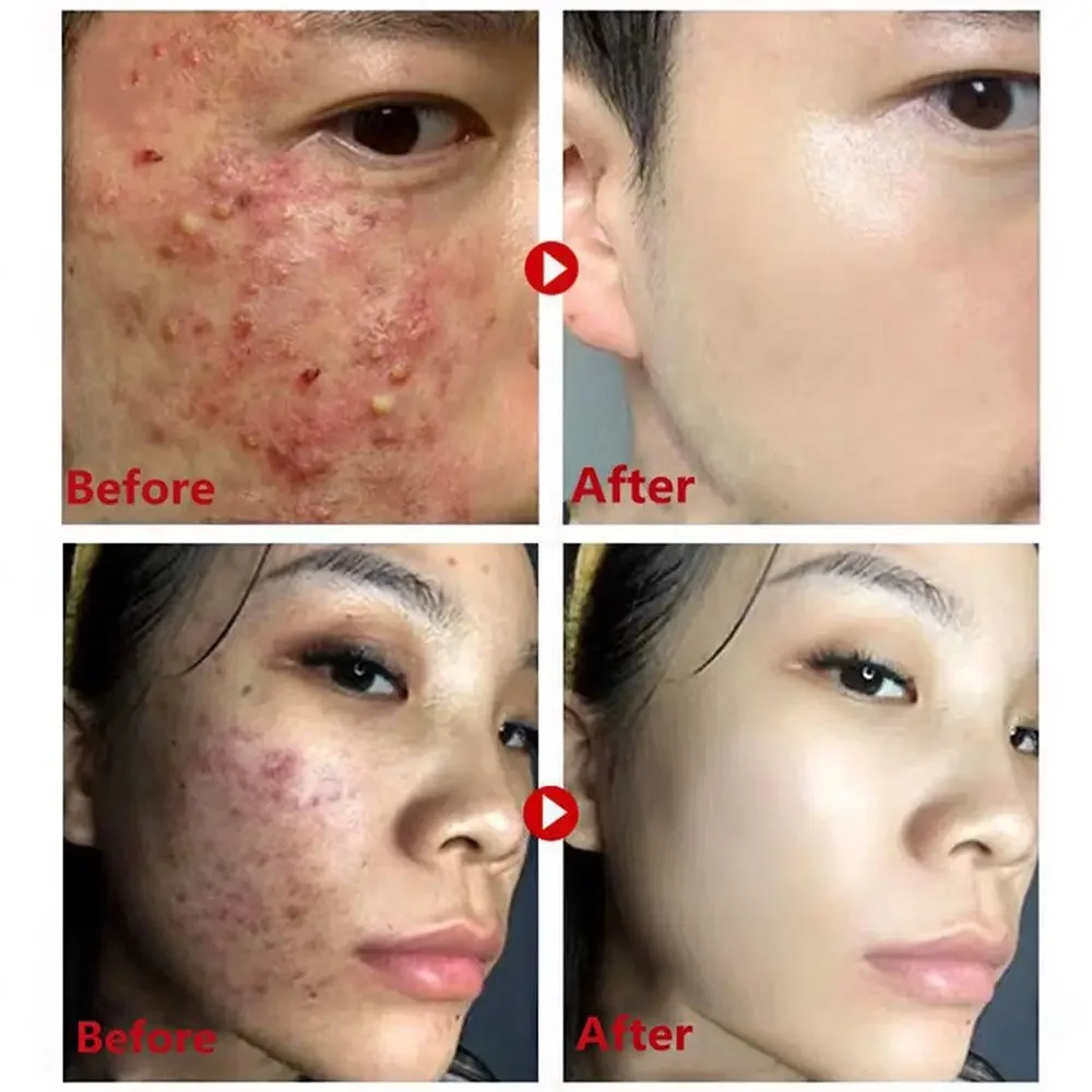 หน้ากากชาเขียวติดลบสิวหัวดําสิ - Green Tea Cleansing Clay Mask บทวิจารณ์และราคา